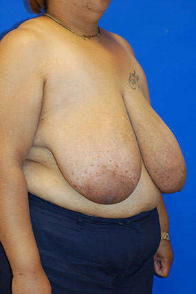 Breast Reduction