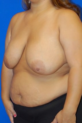 Breast Reduction