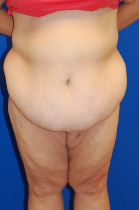 Tummy Tuck Case 4110 Before Photo Tummy Tuck