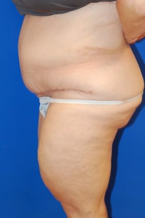 Tummy Tuck Case 4110 After Photo Tummy Tuck