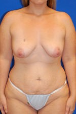 Breast Augmentation