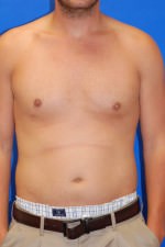 Liposuction