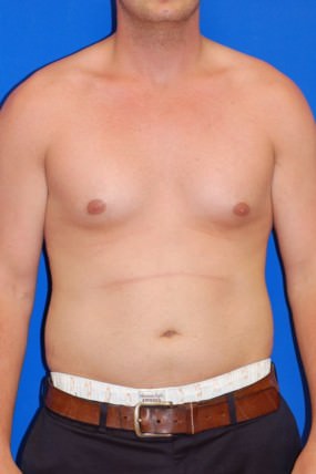 Liposuction