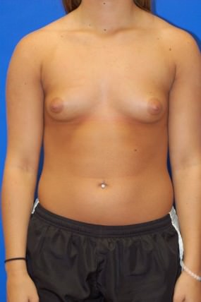 Breast Augmentation