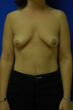 Breast Augmentation