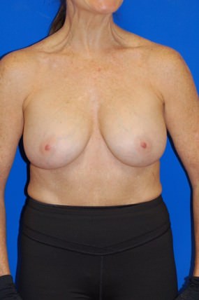 Breast Augmentation