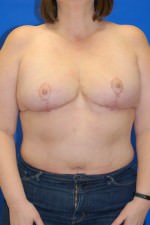 Breast Reduction