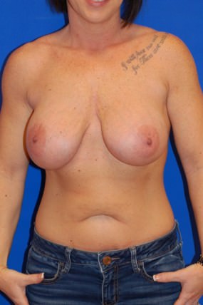 Breast Augmentation