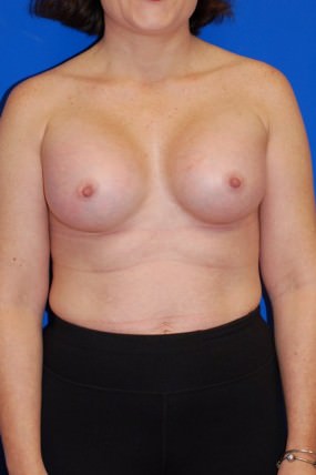 Breast Augmentation