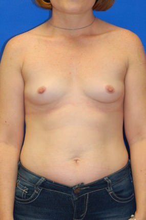 Breast Augmentation