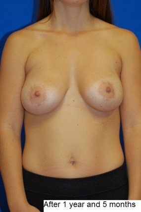 Breast Augmentation