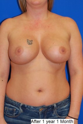 Breast Augmentation