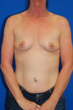 Breast Augmentation