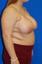 Breast Reduction