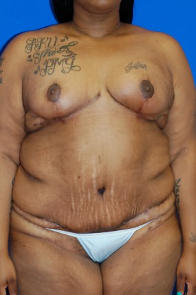 Breast Reduction