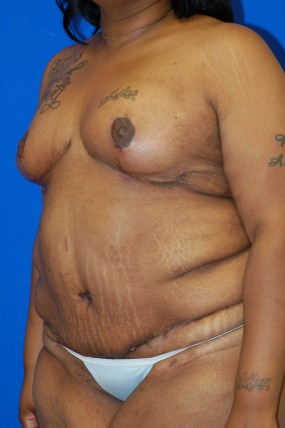 Breast Reduction