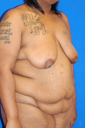 Breast Reduction