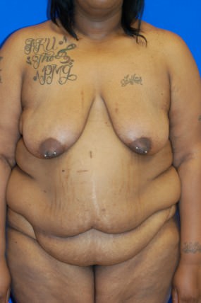 Breast Reduction