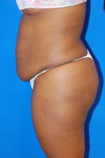 Tummy Tuck