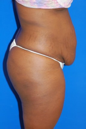 Tummy Tuck