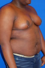 Breast Reduction