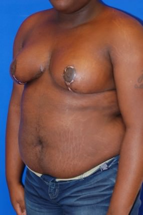 Breast Reduction