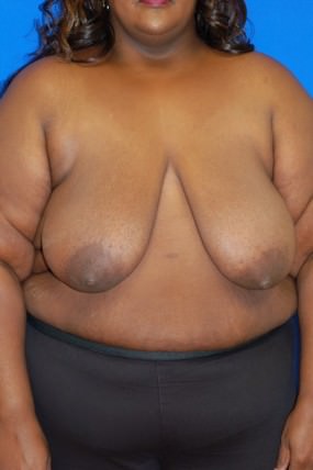 Breast Reduction