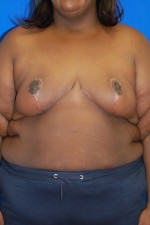 Breast Reduction