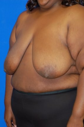 Breast Reduction