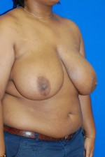 Breast Reduction