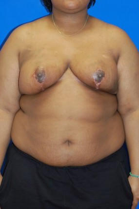 Breast Reduction