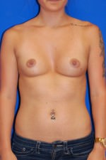 Breast Augmentation