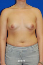 Breast Augmentation