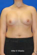 Breast Augmentation