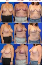 Breast Reduction