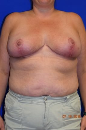 Breast Reduction