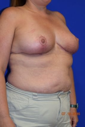 Breast Reduction