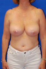 Breast Augmentation