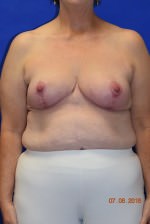 Breast Reduction