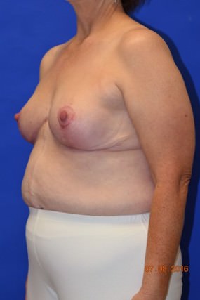 Breast Reduction