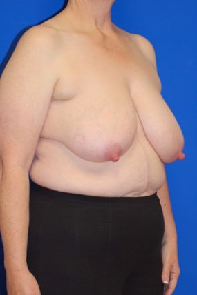 Breast Reduction