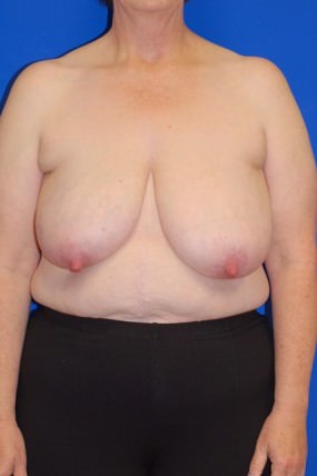 Breast Reduction