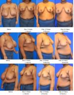 Breast Reduction