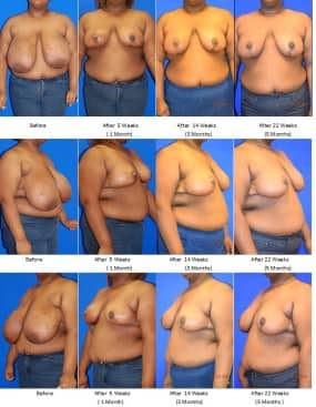 Breast Reduction
