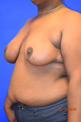 Breast Reduction