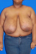 Breast Reduction