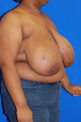 Breast Reduction