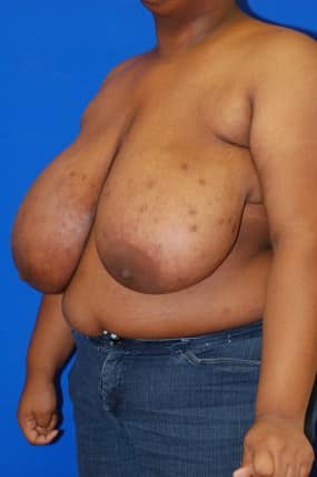 Breast Reduction