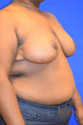 Breast Reduction