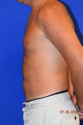 Liposuction Case 4871- creation of 6 pack abs with liposuction After Photo Liposuction